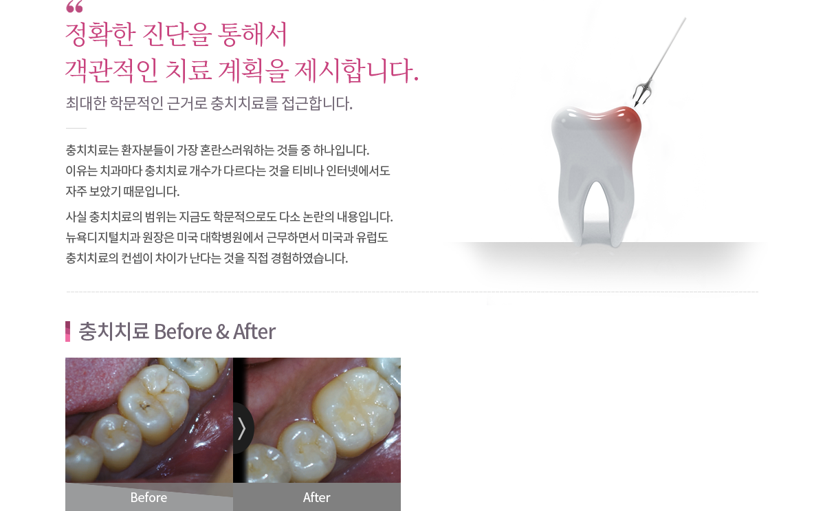 충치치료 내용